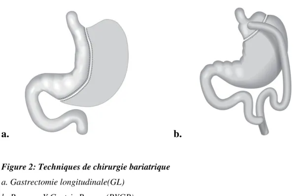 Figure 2: Techniques de chirurgie bariatrique  a. Gastrectomie longitudinale(GL) 