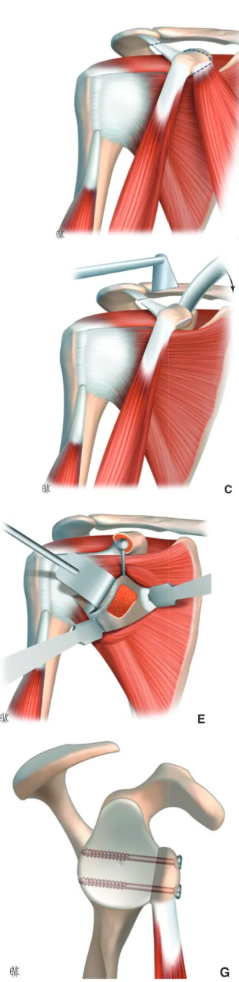 Figure 10 : Technique de  la butée de Patte modifiée par Walch 