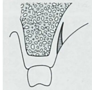 Figure 9 : Prélèvement de conjonctif selon Raetzke (14) 