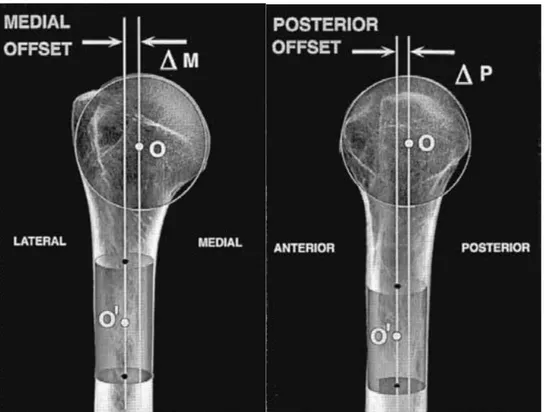 Figure 1 : Déport médial et postérieur de la tête humérale 