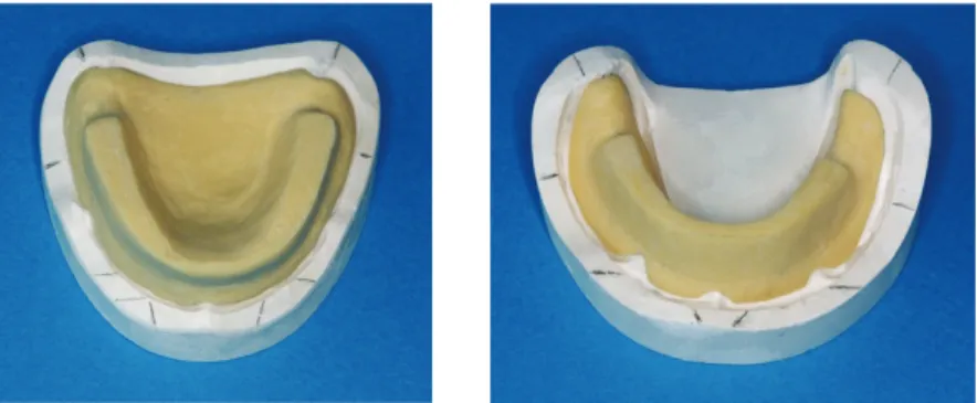 Figure 6: Portes-empreintes individuels maxillaire et mandibulaire avec bourrelet de préhension                                 (photos de l’université de Rennes, aide aux TP) 