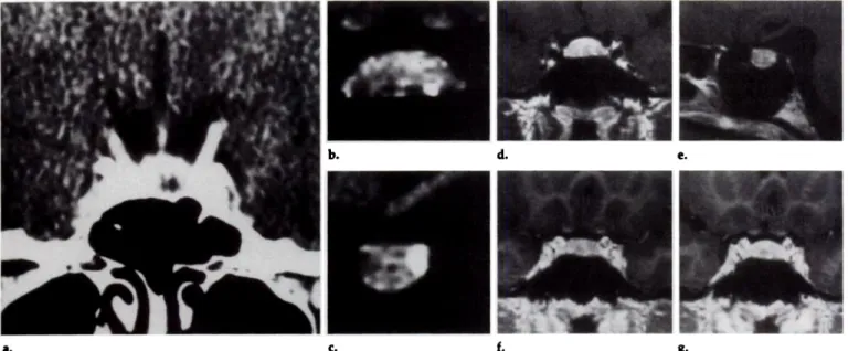 Figure 16. Fibrotic prolactinoma 6 mm in diameter in a patient who received bromocniptine treatment for 3 years