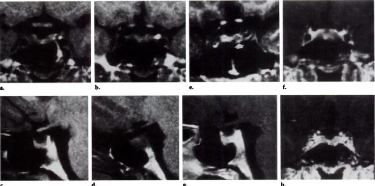 Figure ii. Prolactinoma 3-4 mm in diameter that was treated with bromocriptine. (a, b) Two contiguous sections of coronal Ti-weighted