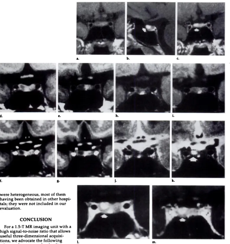 Figure 13 ACTH-secreting microadenoma 4 mm in diameter. (a) Coronal pnegadoliniuin Ti-weighted SE image