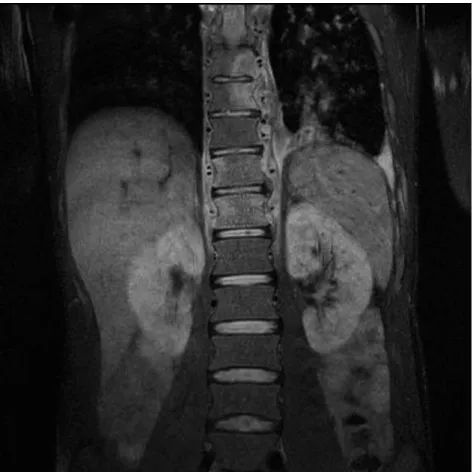 Figure  2 :  IRM  (T2):  Spondylite  multifocale  à  S.  apiospermum  associée  à  des  abcès  paravertébraux  et  une  atteinte  pleurale  par  contiguïté