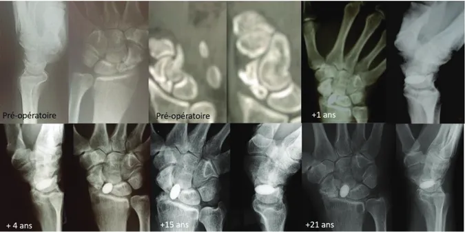 Figure 7 : Radiographies du patient n°2 
