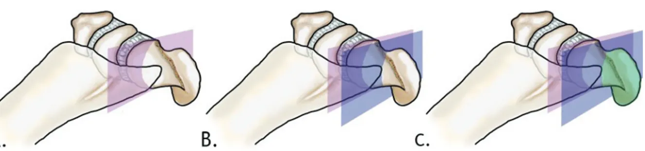 Figure 10 : Types de fracture selon Oura et al : A : Fracture de type « proximale » passant en avant de  l’apex  dorsal du scaphoïde ( violet)  ; B : Fracture  de type « distale intra-articulaire » passant entre l’apex dorsal du  scaphoïde et la surface ar