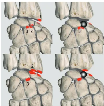 Figure 11 : Localisation de l’arthrose avant et après mise en  place de l’implant ; En haut à gauche SNAC 1, SNAC  2, SNAC 3 ; En haut à droite : Après styloïdectomie et pose de  l’APSI, seul SNAC 3 persistant ; En bas à gauche SLAC1  SLAC2, SLAC3 ; En bas