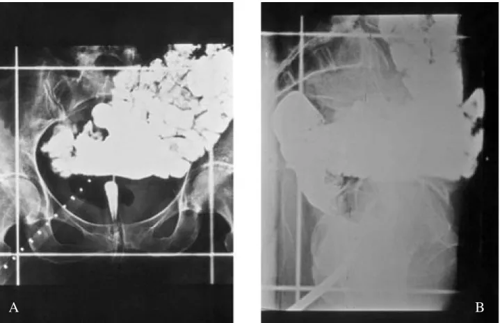 Fig 2 (A,B). Simulation films illustrating the importance of small bowel volume within the irradiation volume