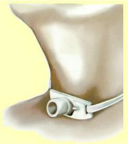 Figure 1 : Schéma d’une canule de trachéotomie  Décanulation : représente l’action d’enlever la canule