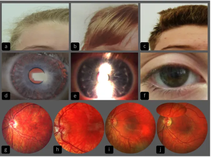 Figure 2: Representative sample of the hair, iris and retinal pigmentation phenotypes in  oculocutaneous type 1 patients, compounds heterozygous with one classical TYR 