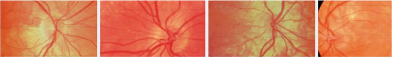 Figure 3 : Photographies de 4 papilles de patients albinos présentant un aspect d’hypoplasie  croissante de gauche à droite sur les 3 premiers et un aspect dysversique sur le dernier cliché