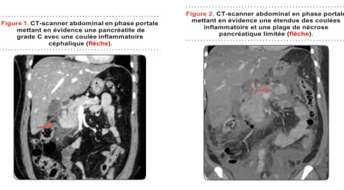 Figure 1. CT-scanner abdominal en phase portale  mettant en évidence une pancréatite de  grade C avec une coulée inflammatoire 