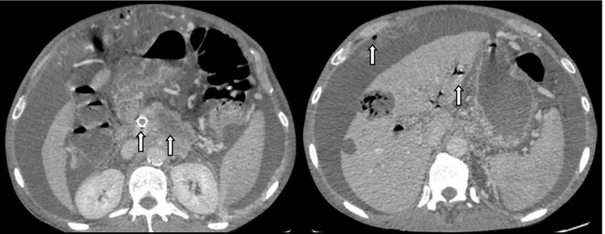 Figure 13 : Abcès hépatique compliquant une prothèse biliaire (Photo empruntée au Dr  Ronot) 