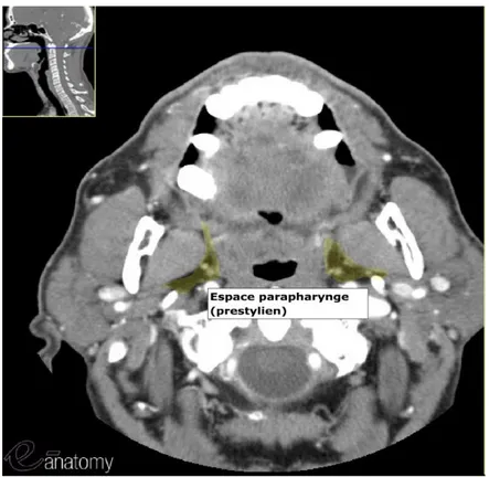 Figure 5 :  Imagerie scannographique de la région pharyngée centrée sur l’espace parapharyngé (préstylien) 