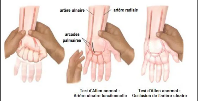 Figure 8. Test d’Allen. 