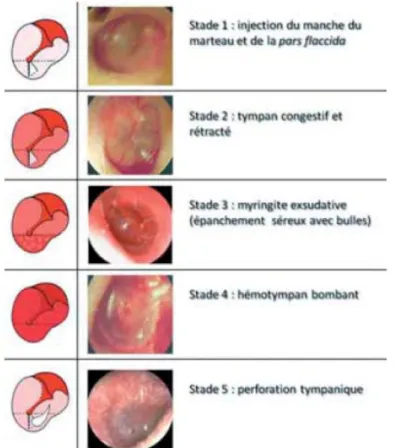 Figure 29: classification des barotraumatismes de l'oreille moyenne selon Halmes  et Harris 