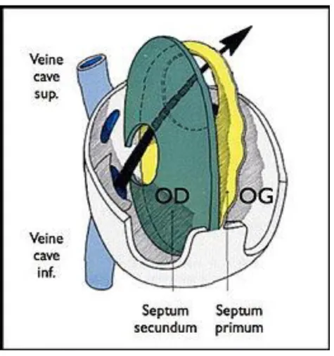 Figure 5 : Représentation d'un foramen ovale perméable. 