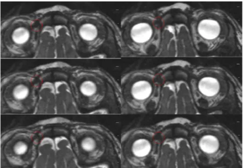 Figure 9 : Coupes axiales jointives en séquence Constructive Interference Steady State (CISS) mettant  en évidence l’hypertrophie de la poulie de l’oblique supérieur droit (entourée en rouge)