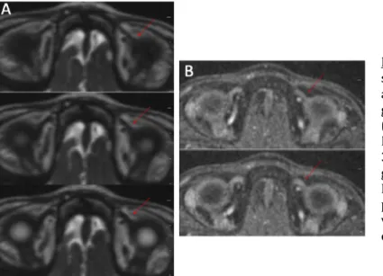 Figure 11 : A. Coupes axiales jointives en  séquence  CISS  retrouvant  un  amincissement  discret  du  tendon  gauche  dès  son  insertion  sclérale  (flèche) par rapport au droit