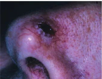 Fig. 3. : Carcinome basocellulaire