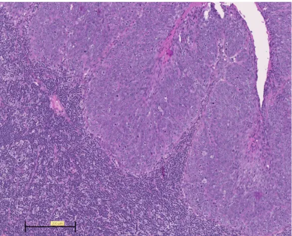 Figure 1: photo de lame histologique représentant la coupe d’un carcinome épidermoïde amygdalien en coloration  HPS (hématoxyline, phloxine, safran) fort grossissement (échelle en bas et à gauche)