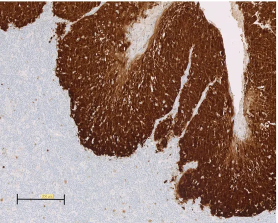 Figure 2: photo d’une lame histologique avec la coupe d’un carcinome épidermoïde amygdalien