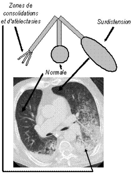 Fig 5: Illustration de l’hétérogénéité pulmonaire 