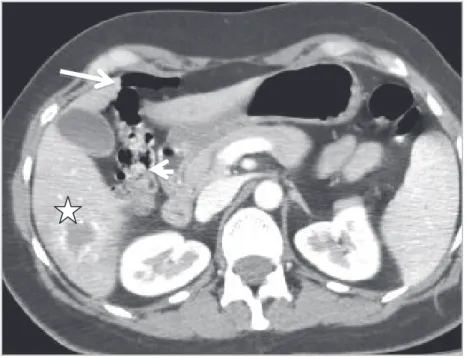 Figure 12 : TDM coupe axiale avec injection intraveineuse de produit de contraste montrant  la migration de l’air au niveau pré hépatique, l’air (flèche) n’étant pas resté piéger au site  désiré entre la tumeurs du segment VI (étoile) et l’angle colique dr