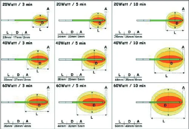 Figure 18 : Thermodestruction par micro-onde illustration du volume d’ablation. 