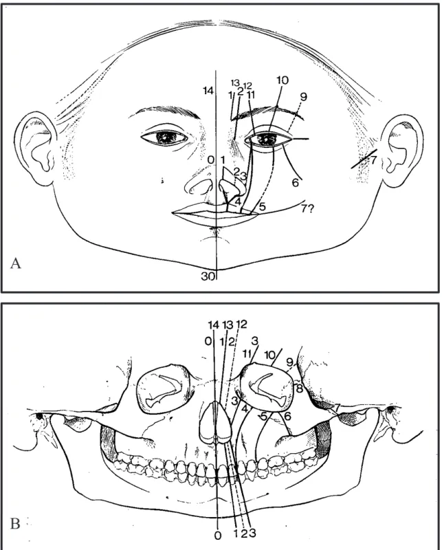 Figure 14 : Nouvelle classification anatomique des fentes faciales, cranio-faciales et latéro-latérales  décrite par Tessier