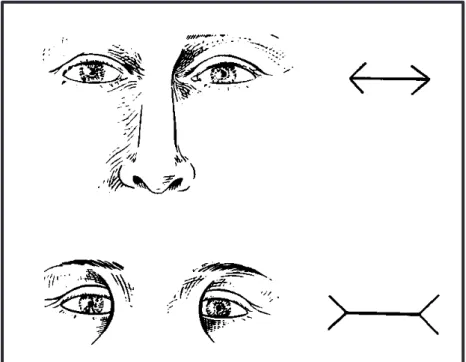 Figure 20 : Le procédé « d’illusionniste ». La réduction d’épicanthus (apparence de télécanthus) et le  rapprochement des sourcils atténuent l’apparence du télorbitisme