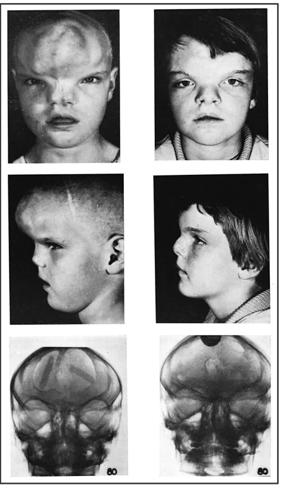 Figure  29 :  Hypertélorisme  orbitaire  d’une  dysraphie  cranio-faciale.  Encéphalocèle  frontale  géante