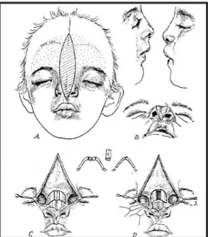 Figure 32 : A et B montrent la quantité de peau et de tissus sous cutanés excisés. C et D montrent les  ostéotomies nasales