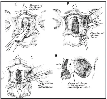 Figure  34 :  Illustration  schématique  de  l’intervention  chirurgicale  permettant  de  corriger  un  hypertélorisme orbitaire congénital ou traumatique