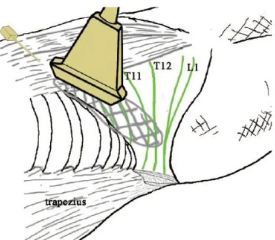 Figure 5 : TAP bloc sous échographie pas voie sous costale 