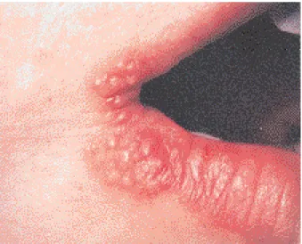 Fig. 1. Herpès labial récurrent dans sa phase initiale vésiculeuse