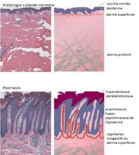 Figure 7 – Histologie de peau normale et d’un patient psoriasique (lésions constituées)  Issue de http://www.nature.com/nature/journal/v445/n7130/fig_tab/nature05663_F1.html 