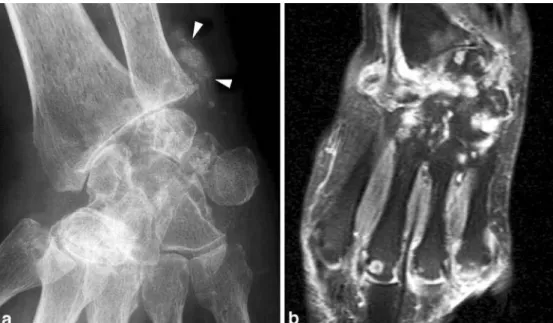 Figure 4 Association de sclérodermie systémique avec une arthrite rhumatoïde. (a) Radiographie montrant une destruction  carpienne et radio-carpienne (en rapport avec l’arthrite rhumatoïde) et des calcifications péri-articulaires (en rapport avec la 