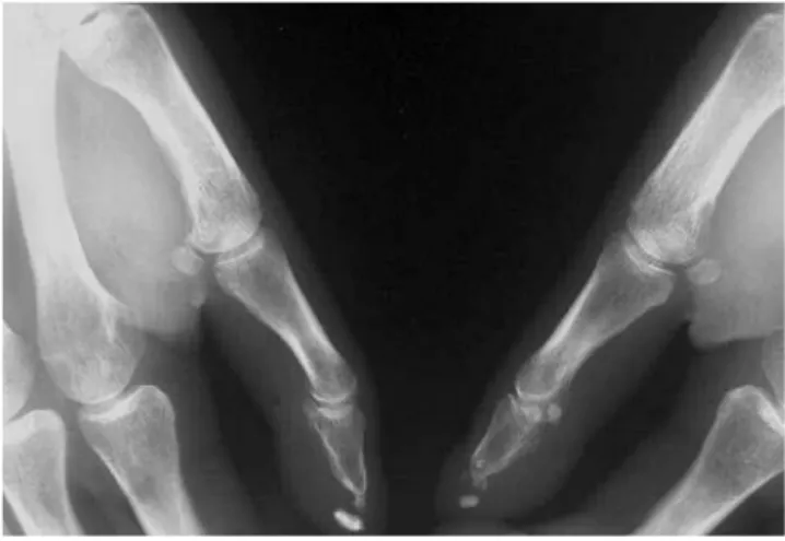 Figure 6 Association de résorption des houppes phalangiennes et de calcifications sous-cutanées