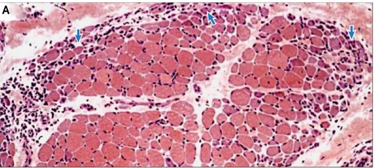 Figure 7 Biopsie musculaire colorée à l'hématoxylin et éosine avec un aspect classique de dermatomyosite avec atrophie  périfasciculaire ( la plupart des fibres atrophiques se localisent en périphérie du fascicule (flèche)) et un infiltrat 