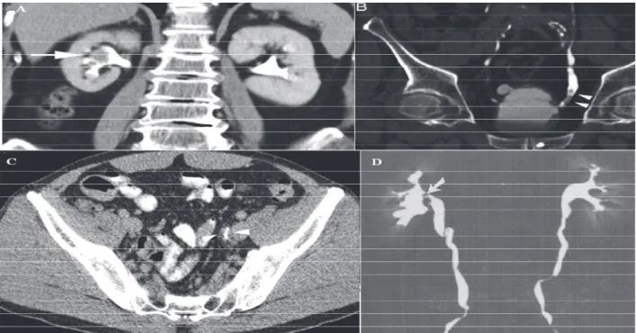 Figure 1. TDM multibarrette :  lésions hypodenses au temps  excrétoire au niveau pyelocalicielle (A&amp;D) et au niveau de  l’uretère pelvien (B &amp;C)