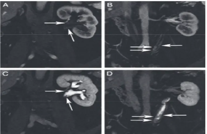 Figure 2. Imagerie par résonance magnétique Carcinome Urothélial  dans le bassinet gauche en T1 (A)et en hypersignal T2 (C); et dans  l’uretère pelvien gauche (B&amp;C)