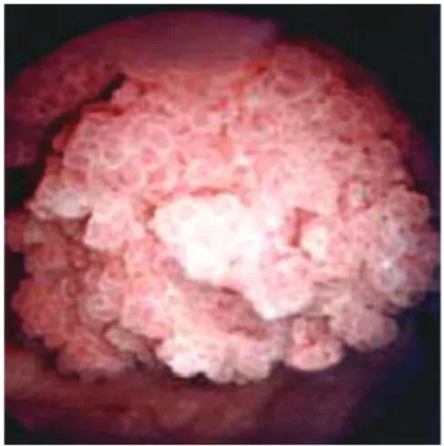 Figure 3. Tumeur de vessie vue en cystoscopie