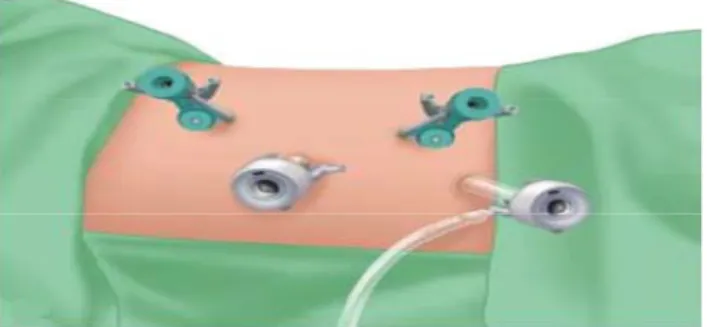 Figure 10. Dispositions des trocarts pour une  néphrourétérectomie laparoscopique gauche.