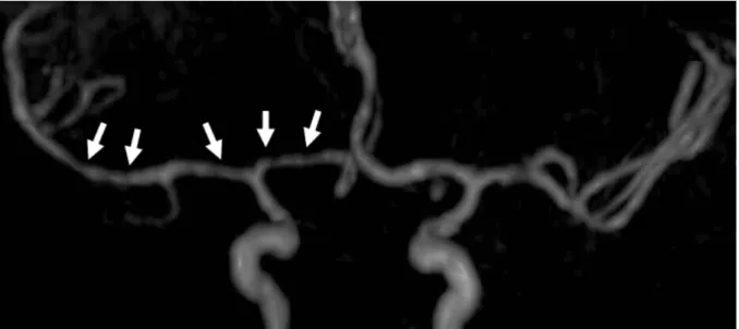 Figure 4 : Vascularite tuberculeuse 