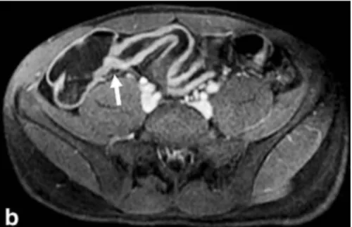 Figure 2 – Evaluation de l’activité de la maladie de Crohn iléale par IRM 