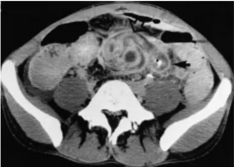 Figure 5 – Abcès intramésentériques compliquant une maladie de Crohn iléale en TDM 