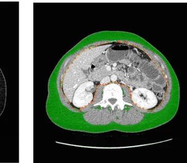 Fig. 1 – Segmentation of visceral, subcutaneous adipose tissues and skeletal muscle at the  L3 vertebra level in the CT scan, according to their density, to measure their surface area