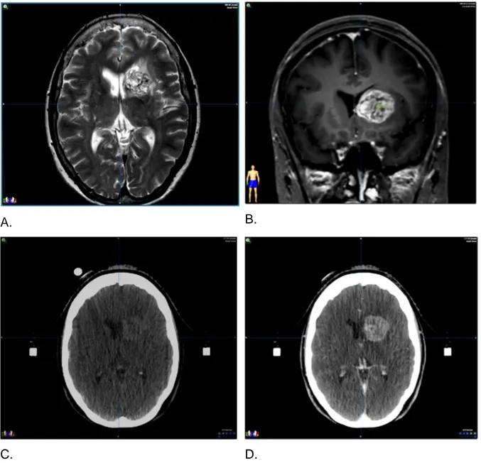 Figure  1.  Radio-anatomie  de  la  lésion  tumorale  secondaire  étudiée  :  A.  Séquence  IRM  diagnostic  T2  coupe  axiale,  B